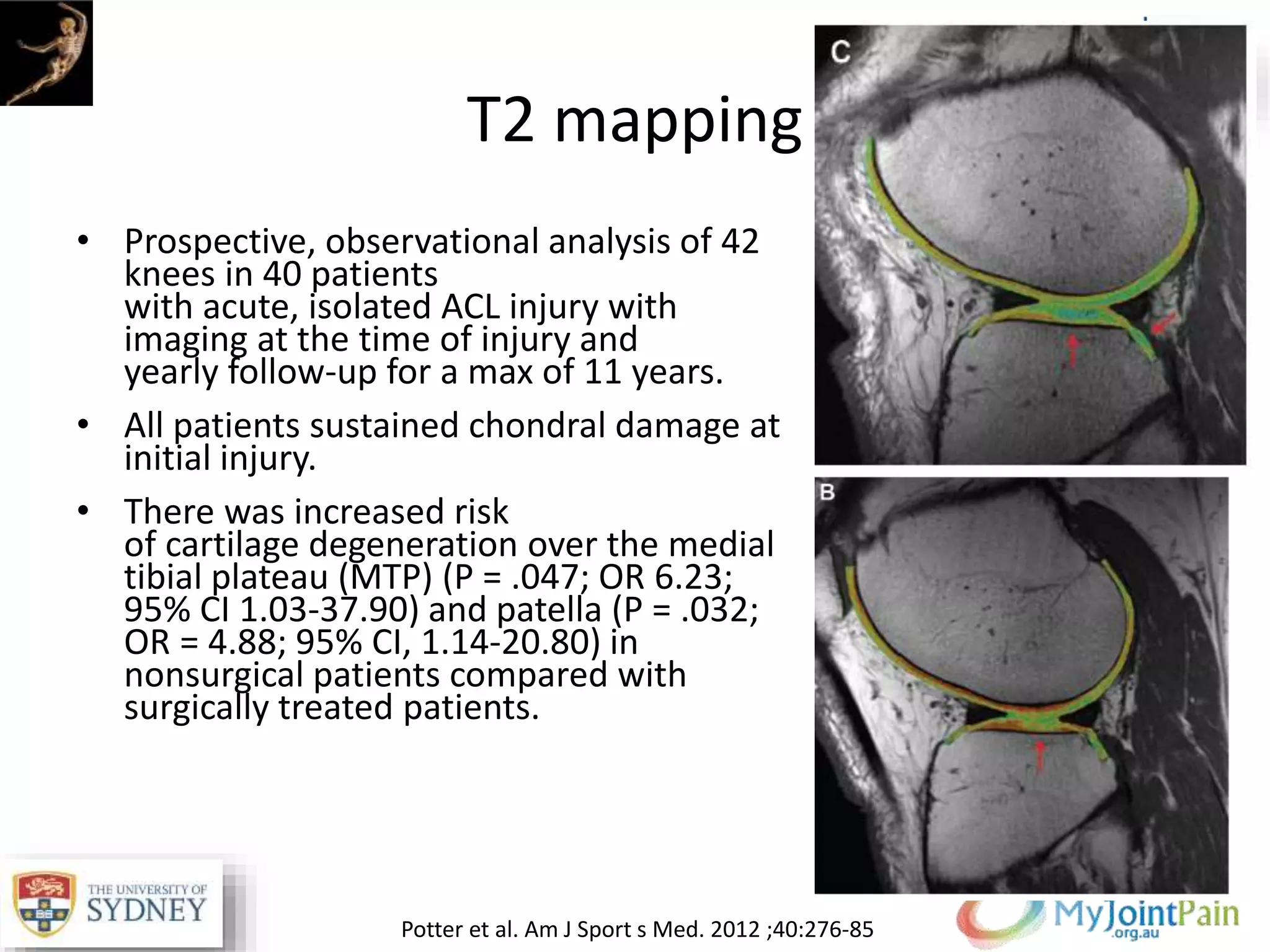 • Prospective, observational analysis of 42
knees in 40 patients
with acute, isolated ACL injury with
imaging at the time of injury and
yearly follow-up for a max of 11 years.
• All patients sustained chondral damage at
initial injury.
• There was increased risk
of cartilage degeneration over the medial
tibial plateau (MTP) (P = .047; OR 6.23;
95% CI 1.03-37.90) and patella (P = .032;
OR = 4.88; 95% CI, 1.14-20.80) in
nonsurgical patients compared with
surgically treated patients.
T2 mapping
Potter et al. Am J Sport s Med. 2012 ;40:276-85
 