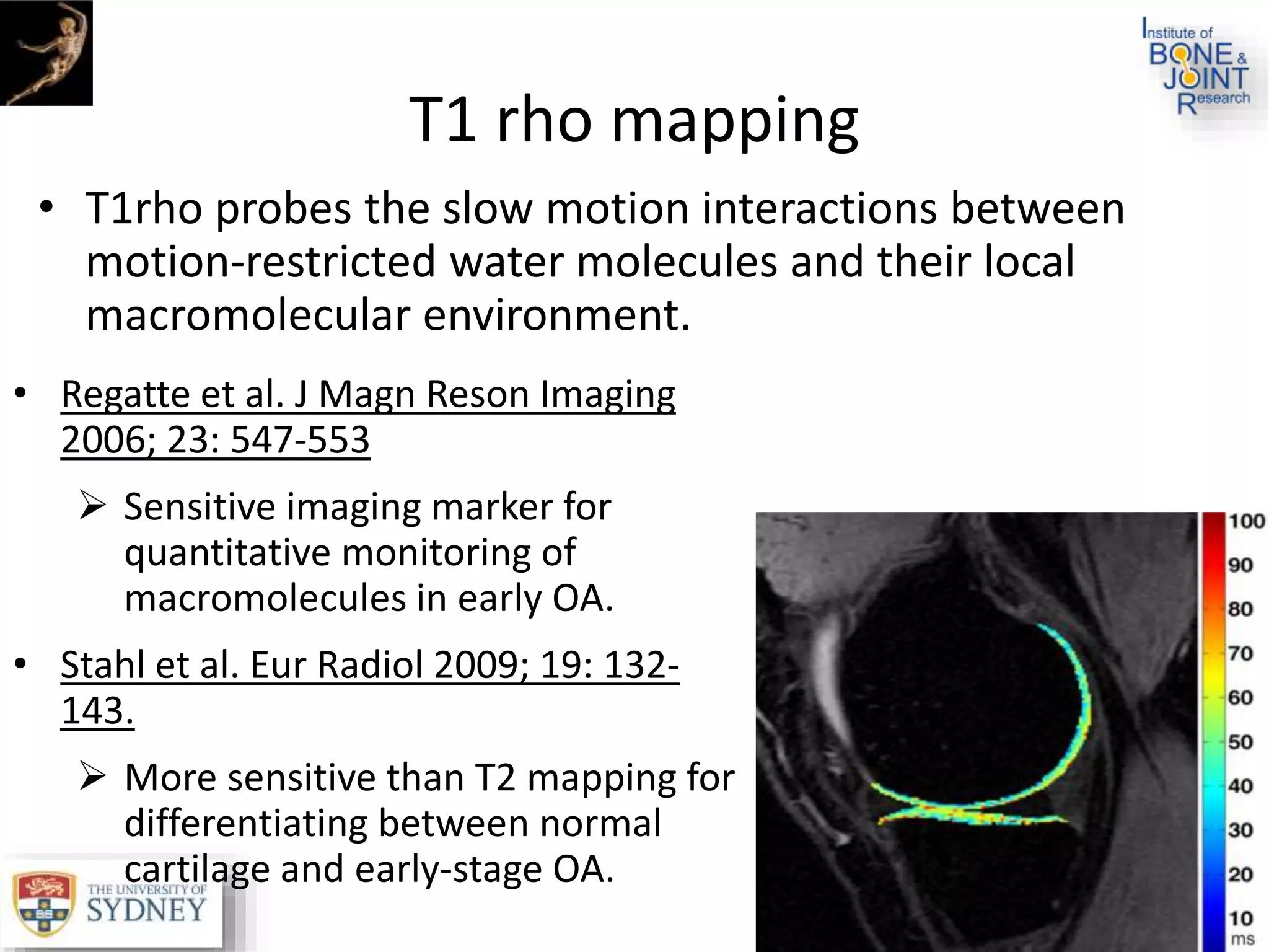 T1 rho mapping
• T1rho probes the slow motion interactions between
motion-restricted water molecules and their local
macromolecular environment.
• Regatte et al. J Magn Reson Imaging
2006; 23: 547-553
 Sensitive imaging marker for
quantitative monitoring of
macromolecules in early OA.
• Stahl et al. Eur Radiol 2009; 19: 132-
143.
 More sensitive than T2 mapping for
differentiating between normal
cartilage and early-stage OA.
 