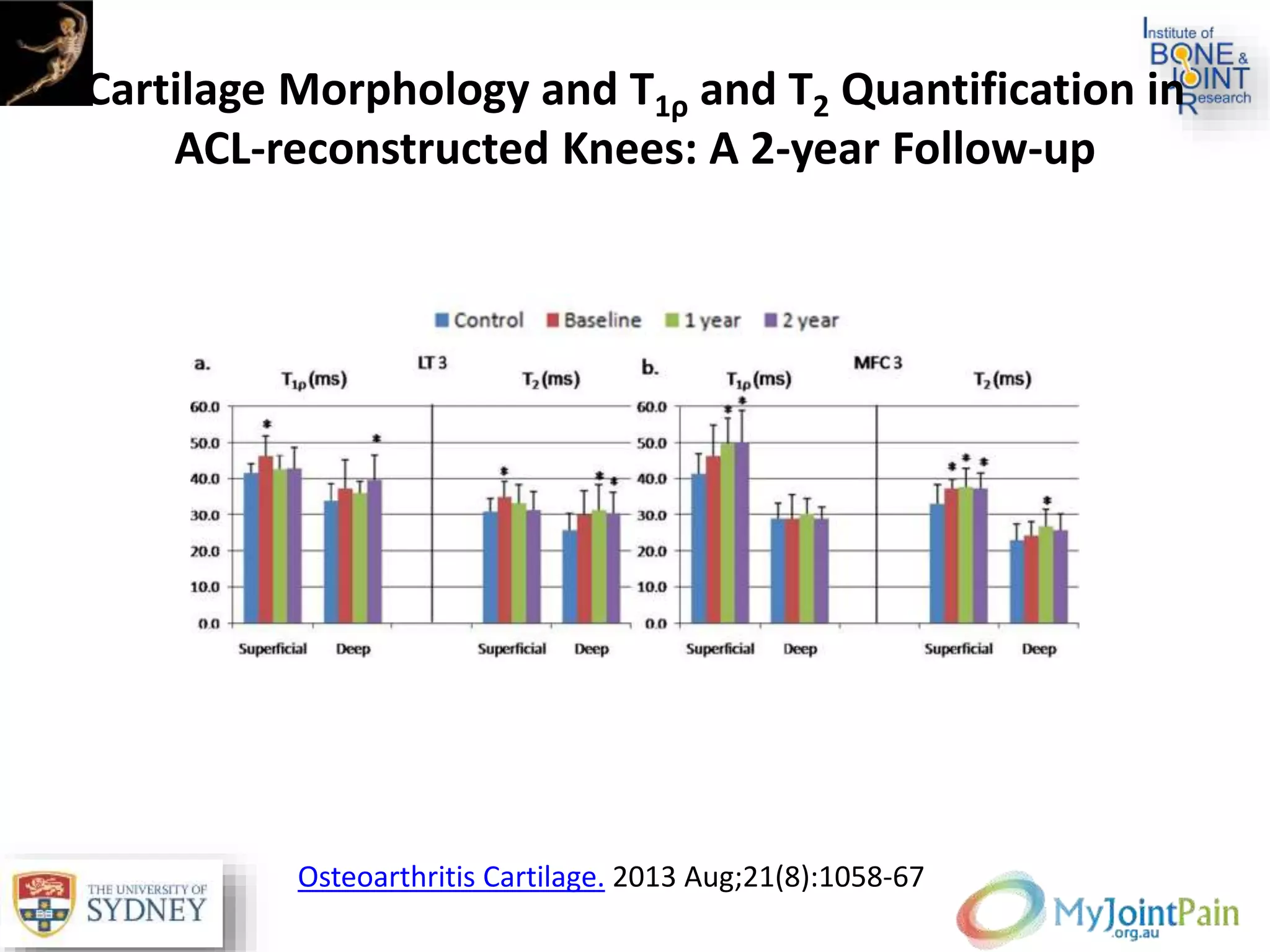 Cartilage Morphology and T1ρ and T2 Quantification in
ACL-reconstructed Knees: A 2-year Follow-up
Osteoarthritis Cartilage. 2013 Aug;21(8):1058-67
 