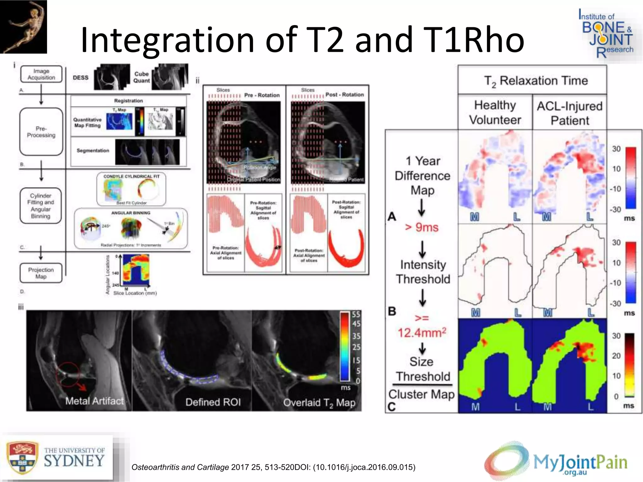 Fig. 2
Osteoarthritis and Cartilage 2017 25, 513-520DOI: (10.1016/j.joca.2016.09.015)
Integration of T2 and T1Rho
 