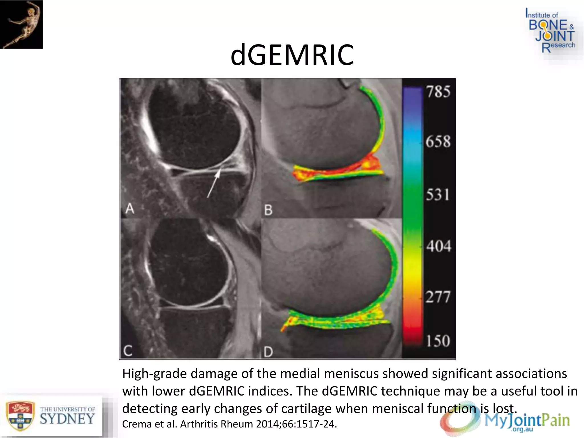 dGEMRIC
High-grade damage of the medial meniscus showed significant associations
with lower dGEMRIC indices. The dGEMRIC technique may be a useful tool in
detecting early changes of cartilage when meniscal function is lost.
Crema et al. Arthritis Rheum 2014;66:1517-24.
 