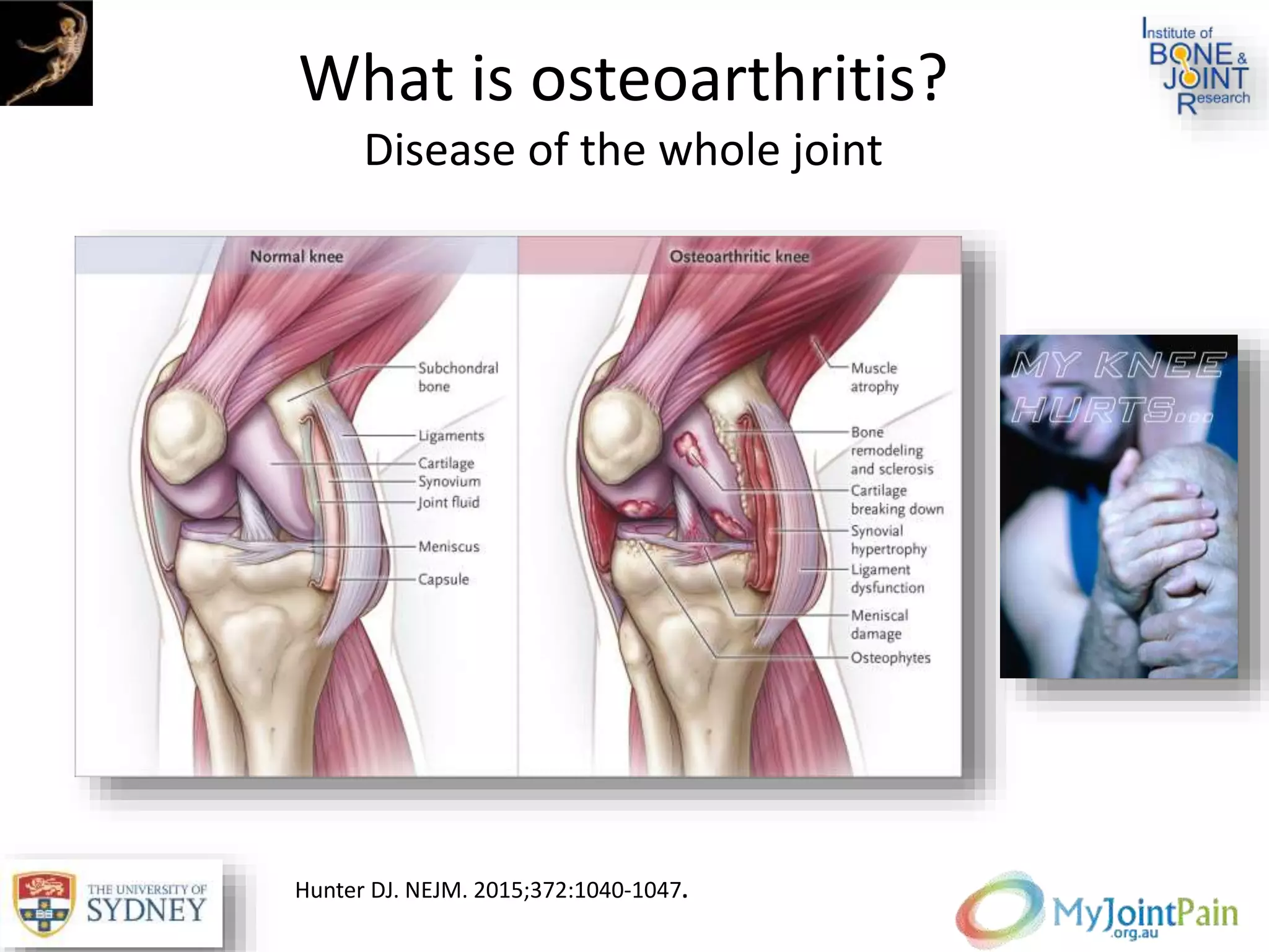 What is osteoarthritis?
Disease of the whole joint
Hunter DJ. NEJM. 2015;372:1040-1047.
 