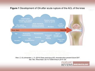 Figure 1 Development of OA after acute rupture of the ACL of the knee
Wen, C. & Lohmander, L. S. (2014) Does post-injury ACL reconstruction prevent future OA?
Nat. Rev. Rheumatol. doi:10.1038/nrrheum.2014.120
Reprinted by permission of SAGE Publications from
Lohmander, L. S. et al. Am. J. Sports Med. 35, 1756–1769 (2007),
© 2007 by American Orthopaedic Society for Sports Medicine
 