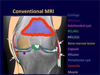 Meniscus
Subchondral cyst
Bone marrow lesion
Effusion
Muscle
PCL/ACL
MCL/LCL
Capsule
Periarticular cyst
Synovitis
Cartilage
Conventional MRI
 