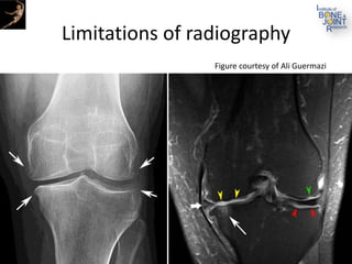Limitations of radiography
Figure courtesy of Ali Guermazi
 