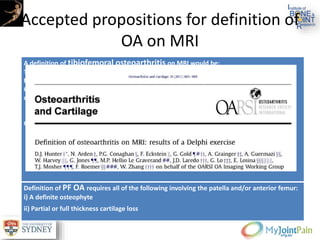 Accepted propositions for definition of
OA on MRI
A definition of tibiofemoral osteoarthritis on MRI would be:
The presence of both group [A] features or one group [A] feature and two or more group [B]
features
Group [A] after exclusion of joint trauma within the last 6 months (by history) and exclusion
of inflammatory arthritis (by radiographs, history and laboratory parameters):
i) Definite osteophyte formation§
ii) Full thickness cartilage loss
Group [B]:
i) Subchondral bone marrow lesion or cyst not associated with meniscal or ligamentous
attachments
ii) Meniscal subluxation, maceration or degenerative (horizontal) tear
iii) Partial thickness cartilage loss (where full thickness loss is not present)
iv) Bone attrition
Definition of PF OA requires all of the following involving the patella and/or anterior femur:
i) A definite osteophyte
ii) Partial or full thickness cartilage loss
 