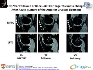Five‐Year Followup of Knee Joint Cartilage Thickness Changes
After Acute Rupture of the Anterior Cruciate Ligament
Arthritis & Rheumatology
Volume 67, Issue 1, pages 152-161, 27 DEC 2014 DOI: 10.1002/art.38881
http://onlinelibrary.wiley.com/doi/10.1002/art.38881/full#art38881-fig-0001
 