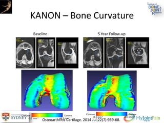 KANON – Bone Curvature
-0.1 mm-1 +0.1 mm-1
Concave Convex
-0.1 mm-1 +0.1 mm-1
Concave Convex
Baseline 5 Year Follow-up
Osteoarthritis Cartilage. 2014 Jul;22(7):959-68.
 