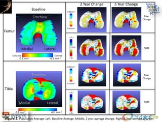 LateralMedial
Trochlea
LateralMedial
Trochlea
Femur
Tibia
Baseline
2 Year Change 5 Year Change
Raw
Change
SRM
Raw
Change
SRM
-0.1 mm-1 +0.1 mm-1
-0.1 mm-1 +0.1 mm-1
-0.01mm-1
+0.01mm-1
-1.0 z
+1.0 z
-0.01mm-1
+0.01mm-1
-1.0 z
+1.0 z
Concave Convex
Figure 2. Population Average: Left, Baseline Average. Middle, 2 year average change. Right, 5 Year average changes
0.0
 