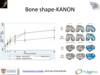 Bone shape-KANON
Osteoarthritis Cartilage. 2019 Apr;27(4):638-645.
 