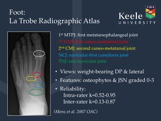 Osteoarthritis of the Foot and Ankle | PPTX