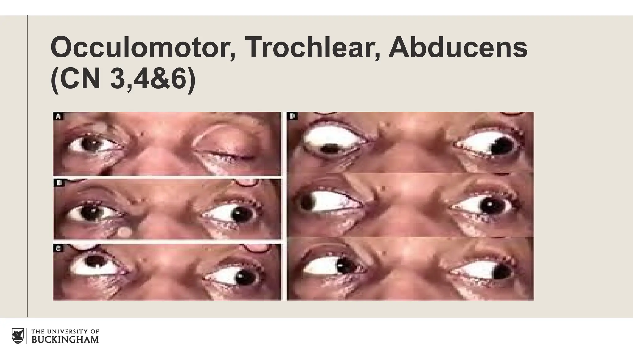 Occulomotor, Trochlear, Abducens
(CN 3,4&6)
 