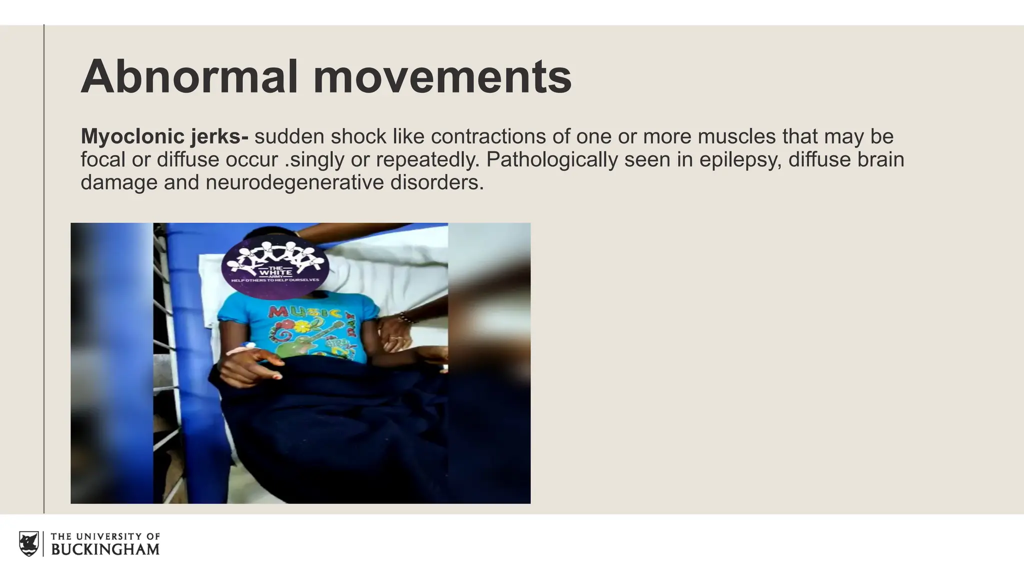 Abnormal movements
Myoclonic jerks- sudden shock like contractions of one or more muscles that may be
focal or diffuse occur .singly or repeatedly. Pathologically seen in epilepsy, diffuse brain
damage and neurodegenerative disorders.
 