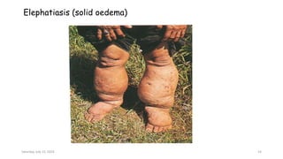 Elephatiasis (solid oedema)
Saturday, July 13, 2024 14
 