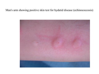 Comprehensive Overview of Echinococcus granulosus: Morphology, Life ...