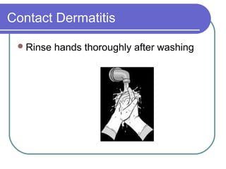 Contact Dermatitis

  Rinse   hands thoroughly after washing
 