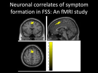 Neuronal correlates of symptom
formation in FSS: An fMRI study
 