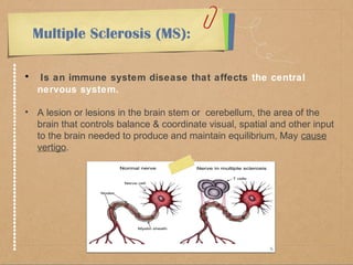 Multiple Sclerosis (MS): 
• Is an immune system disease that affects the central 
nervous system. 
• A lesion or lesions in the brain stem or cerebellum, the area of the 
brain that controls balance & coordinate visual, spatial and other input 
to the brain needed to produce and maintain equilibrium, May cause 
vertigo. 
 