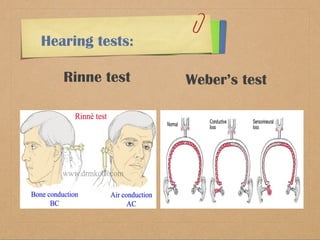 Weber’s test 
Hearing tests: 
Rinne test 
 