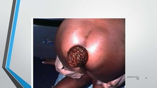 RECTAL PROLAPSE
4/16/2024 6:26:53
AM
35
 