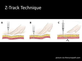 Z-Track Technique
picture via thenursepath.com
 