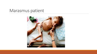 Marasmus patient
 