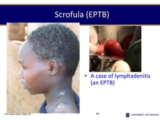Scrofula (EPTB)
• A case of lymphadenitis
(an EPTB)
Prof. Kwasi Addo, SON, UG 24
 