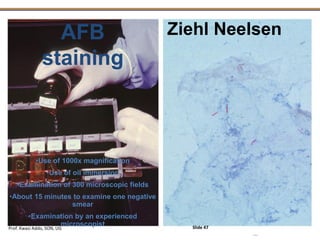AFB
staining
Ziehl Neelsen
•Use of 1000x magnification
•Use of oil immersion
•Examination of 300 microscopic fields
•About 15 minutes to examine one negative
smear
•Examination by an experienced
microscopist
Prof. Kwasi Addo, SON, UG Slide 47
 