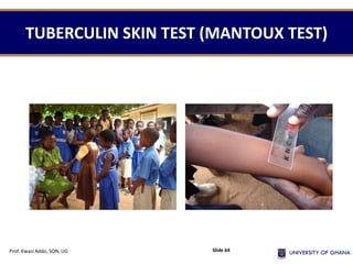 TUBERCULIN SKIN TEST (MANTOUX TEST)
Prof. Kwasi Addo, SON, UG Slide 64
 