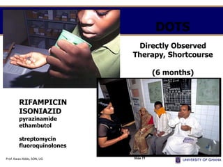 Directly Observed
Therapy, Shortcourse
(6 months)
DOTS
RIFAMPICIN
ISONIAZID
pyrazinamide
ethambutol
streptomycin
fluoroquinolones
Prof. Kwasi Addo, SON, UG Slide 77
 