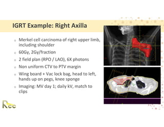 Axillary Clips Session 8 - IGRT_ Guidelines for Matching _ Alignment, Methods ...