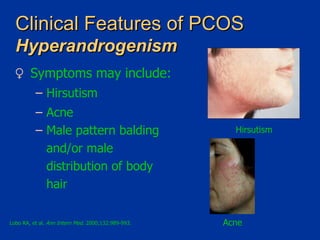 Clinical Features of PCOS   Hyperandrogenism Symptoms may include: Hirsutism Acne Male pattern balding and/or male distribution of body hair Lobo RA, et al.  Ann Intern Med . 2000;132:989-993. Hirsutism Acne 