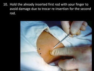 Session IV Implant insertion.ppt