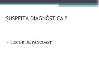 SUSPEITA DIAGNÓSTICA ?



• TUMOR DE PANCOAST
 
