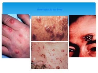 Manifestação cutânea
 