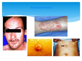 Manifestação cutânea
 