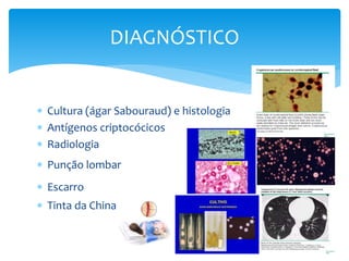  Cultura (ágar Sabouraud) e histologia
 Antígenos criptocócicos
 Radiologia
 Punção lombar
 Escarro
 Tinta da China
DIAGNÓSTICO
 