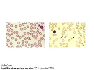 UpToDate  Last literature review version 17.1:  Janeiro 2009  