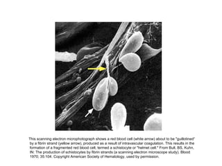 This scanning electron microphotograph shows a red blood cell (white arrow) about to be "guillotined“ by a fibrin strand (yellow arrow), produced as a result of intravascular coagulation. This results in the formation of a fragmented red blood cell, termed a schistocyte or "helmet cell." From Bull, BS, Kuhn, IN: The production of schistocytes by fibrin strands (a scanning electron microscope study). Blood 1970; 35:104. Copyright American Society of Hematology, used by permission.  