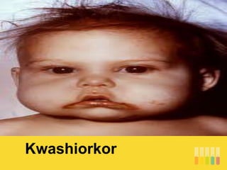 Kwashiorkor
 
