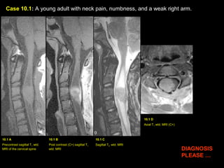 Case 10.1: A young adult with neck pain, numbness, and a weak right arm.
10.1 A
Precontrast sagittal T1 wtd.
MRI of the cervical spine
10.1 B
Post contrast (C+) sagittal T1
wtd. MRI
10.1 C
Sagittal T2 wtd. MRI
10.1 D
Axial T1 wtd. MRI (C+)
DIAGNOSIS
PLEASE …
 