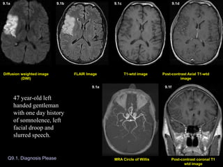 Q9.1. Diagnosis Please
Post-contrast Axial T1-wtd
image
T1-wtd image
FLAIR Image
Post-contrast coronal T1
wtd image
MRA Circle of Willis
Diffusion weighted image
(DWI)
Diffusion weighted image (DWI)
9.1a 9.1b 9.1c 9.1d
9.1e 9.1f
47 year-old left
handed gentleman
with one day history
of somnolence, left
facial droop and
slurred speech.
 