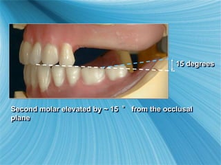 Second molar elevated by ~ 15 ° from the occlusal
plane
15 degrees
 