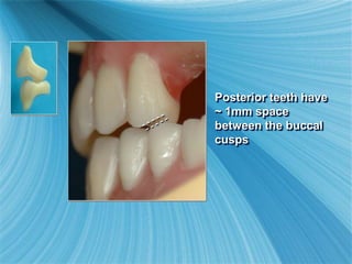 Posterior teeth have
~ 1mm space
between the buccal
cusps
 
