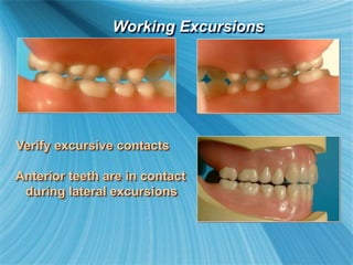 Verify excursive contacts
Anterior teeth are in contact
during lateral excursions
Working Excursions
 