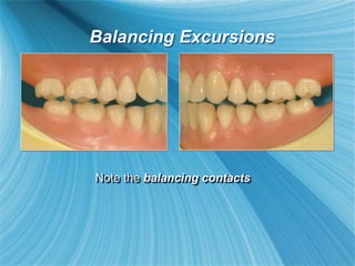 Note the balancing contacts
Balancing Excursions
 