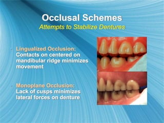 Occlusal Schemes
Attempts to Stabilize Dentures
 Lingualized Occlusion:
Contacts on centered on
mandibular ridge minimizes
movement
 Monoplane Occlusion:
Lack of cusps minimizes
lateral forces on denture
 