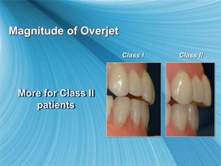 Magnitude of Overjet
More for Class II
patients
Class I Class II
 