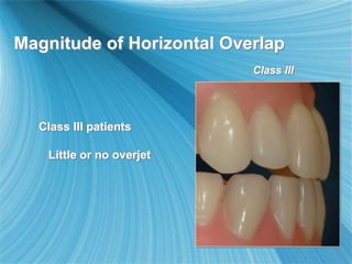 Magnitude of Horizontal Overlap
Class III patients
Little or no overjet
Class III
 
