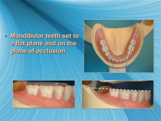 • Mandibular teeth set to
a flat plane and on the
plane of occlusion
 